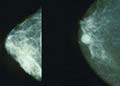A City of Hope-led study found that the use of low-dose aspirin (81mg) reduces the risk of breast cancer