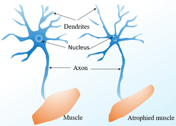 Differences between normal and ALS patients in muscle