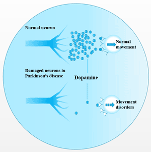 The absence of neurotransmitter dopamine is the main cause of Parkinson's disease