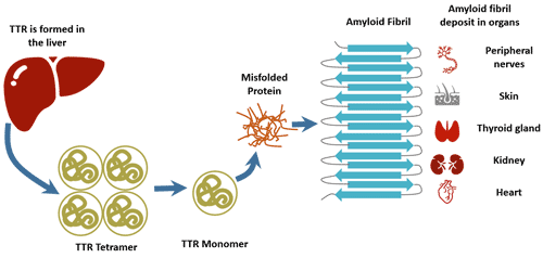 The pathogenesis of transthyretin familial amyloid polyneuropathy