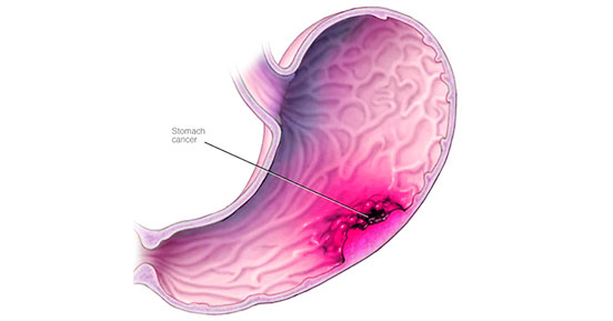 Gastric cancer begins in the cells of your stomach