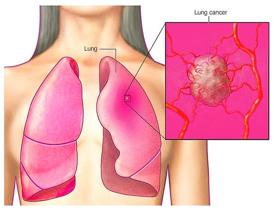 Lung cancer begins in the cells of your lungs