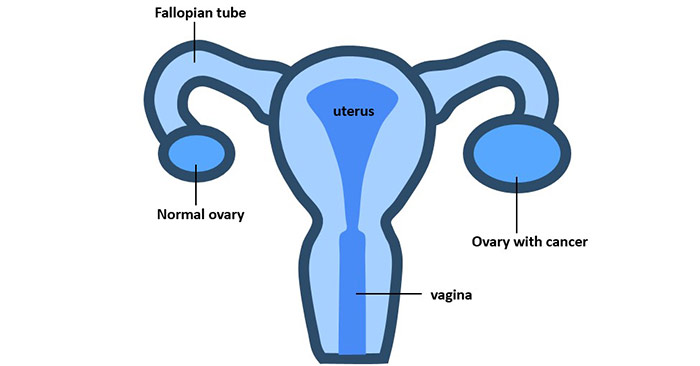 Ovarian Cancer The Silent Killer Cusabio 