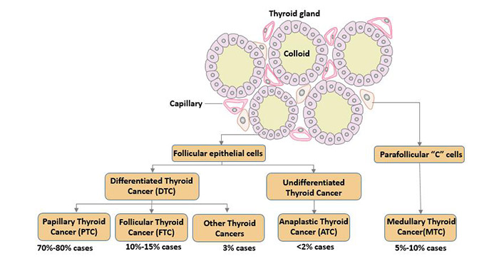 Type of thyroid cancer