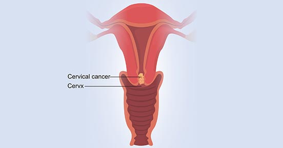 Cervical Cancer, One of the Most Common Killers of Women
