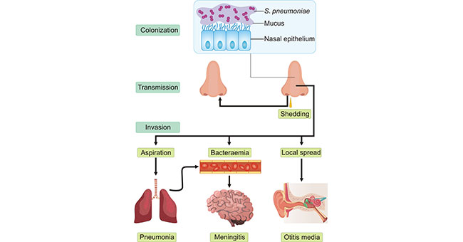 Streptococcus pneumoniae, a Primary Cause of Pneumonia