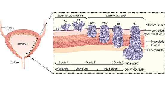 Types and stages of bladder cancer