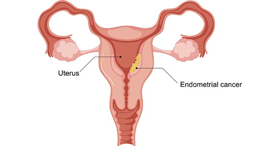a diagram of endometrial cancer