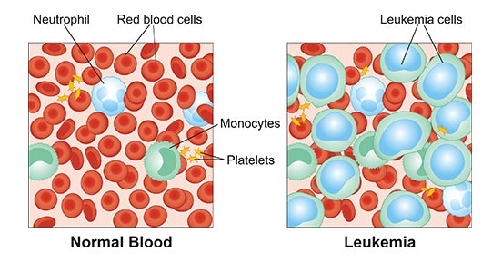 a diagram of components of normal blood and leukemia