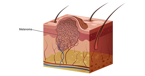 a diagram of melanoma