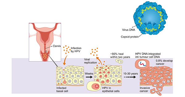 hpv and cervical cancer research paper