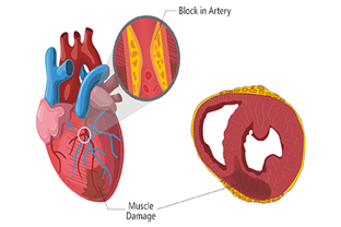 Myocardial Infarction