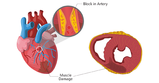 Myocardial infarction