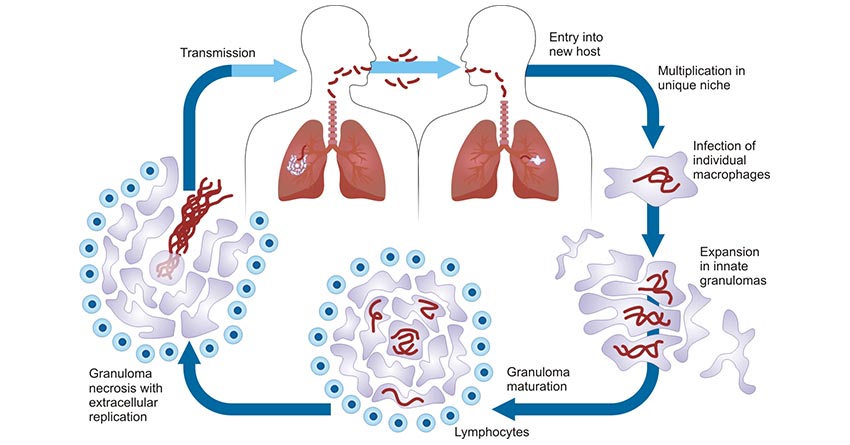 Tuberculosis--A Resurgent 