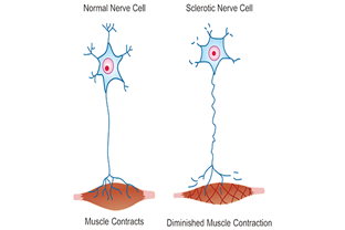 What Is the Cause of Amyotrophic Lateral Sclerosis?