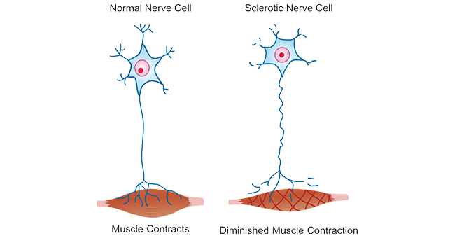 Comparison of normal nerve cell and sclerotic nerve cell