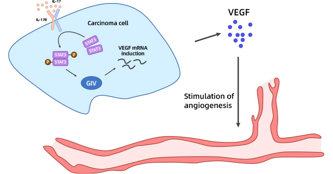 IL-17A regulates angiogenic factors in tumors