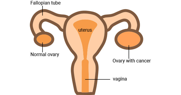 Ovarian cancer