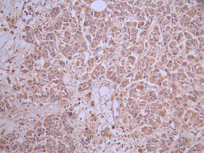 CD33 (Siglec-3) Signaling Pathways and Disease Mechanisms: Roles in Acute Myeloid Leukemia, Alzheimer’s Disease and Immune Regulation
