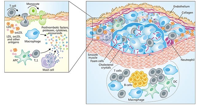 Immune components of the atherosclerotic plaque