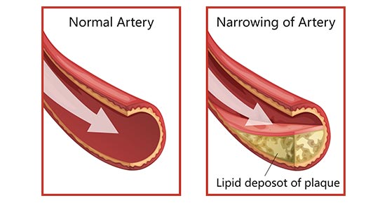 Drawing of how the coronary arteries get clogged up with plaque