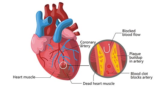 The diagram of heart attack