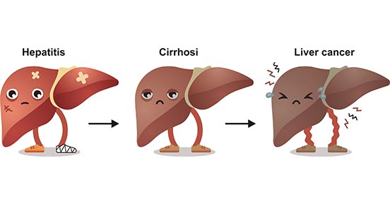 The Progress of Hepatocellular Injury