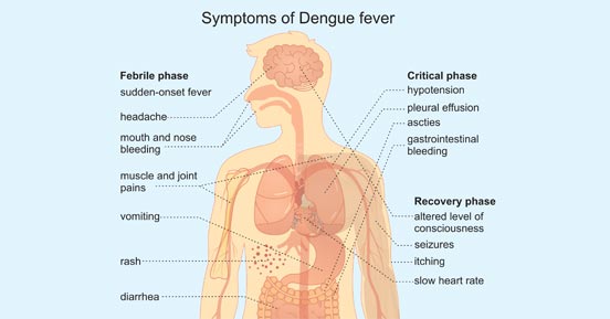 Symptoms of Dengue Fever