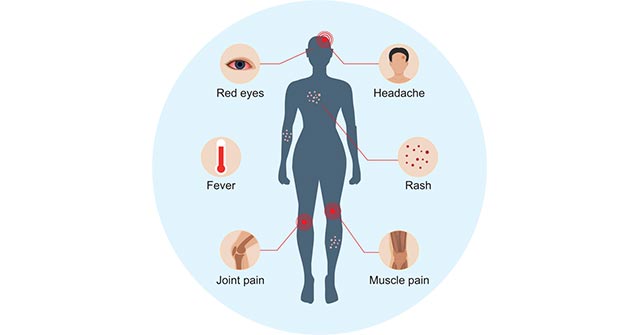 Diseases and Symptoms of Zika Virus