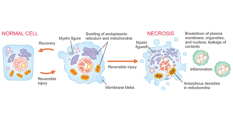Diagram of necrosis of a cell