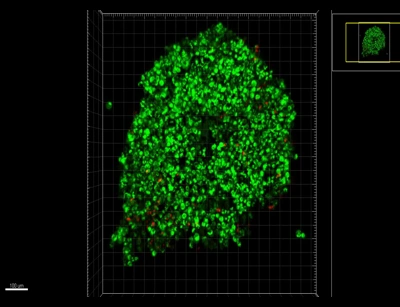 3D Reconstruction of Large Breast Cancer Organoid Mass