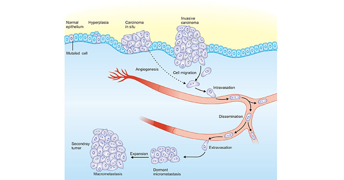 Cancer progression