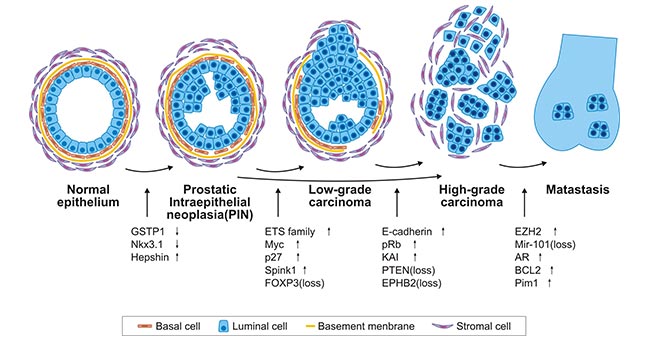 Model of prostate cancer progression