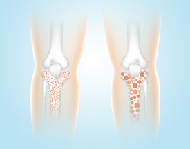 Osteoporosis