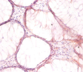 Immunohistochemistry of paraffin-embedded human colon cancer using CSB-PA00135A0Rb at dilution of 1:50