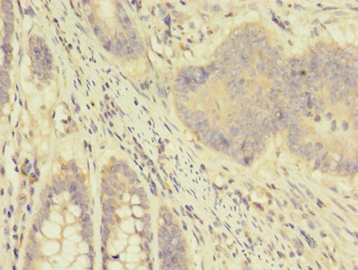 Immunohistochemistry of paraffin-embedded human colon cancer using CSB-PA001935EA01HU at dilution of 1:100