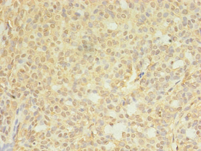 Immunohistochemistry of paraffin-embedded human breast cancer using CSB-PA006176LA01HU at dilution of 1:100