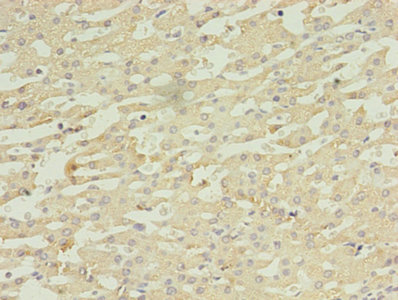 Immunohistochemistry of paraffin-embedded human liver cancer using CSB-PA006500EA01HU at dilution of 1:100