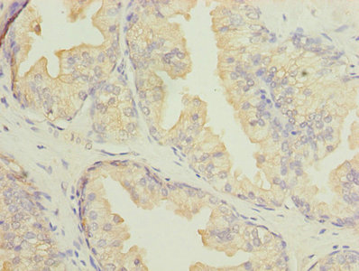 Immunohistochemistry of paraffin-embedded human prostate cancer using CSB-PA007047LA01HU at dilution of 1:100