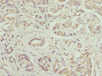 Immunohistochemistry of paraffin-embedded human pancreatic cancer using CSB-PA008545EA01HU at dilution of 1:100