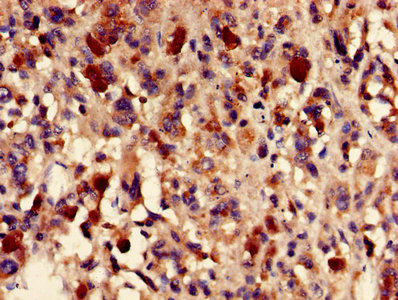 Immunohistochemistry of paraffin-embedded human melanoma using CSB-PA008659LA01HU at dilution of 1:100