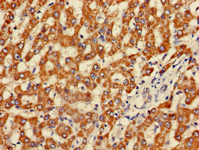Immunohistochemistry of paraffin-embedded human liver cancer using CSB-PA008659LA01HU at dilution of 1:100