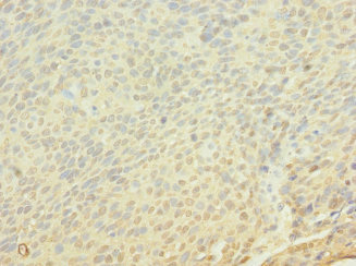 Immunohistochemistry of paraffin-embedded human cervical cancer using CSB-PA009005LA01HU at dilution of 1:100