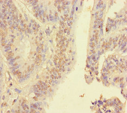 Immunohistochemistry of paraffin-embedded human colon cancer using CSB-PA010602DA01HU at dilution of 1:100 Immunohistochemistry of paraffin-embedded human colon cancer using CSB-PA010602DA01HU at dilution of 1:100