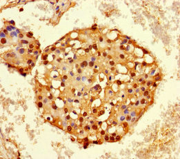 Immunohistochemistry of paraffin-embedded human breast cancer using CSB-PA010602DA01HU at dilution of 1:100