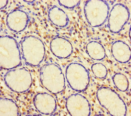 Immunohistochemistry of paraffin-embedded human gastric cancer using CSB-PA010909LA01HU at dilution of 1:100