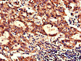 Immunohistochemistry of paraffin-embedded human lung cancer using CSB-PA015653LA01HU at dilution of 1:100