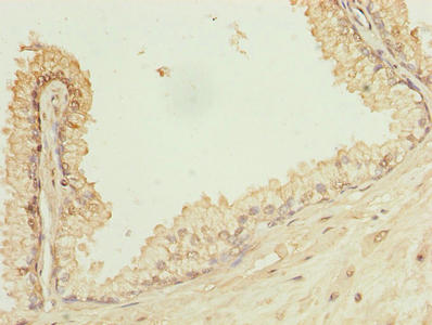 Immunohistochemistry of paraffin-embedded human prostate cancer using CSB-PA018299LA01HU at dilution of 1:100
