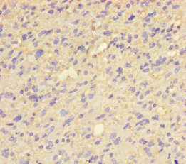 Immunohistochemistry of paraffin-embedded human glioma using CSB-PA019135LA01HU at dilution of 1:100