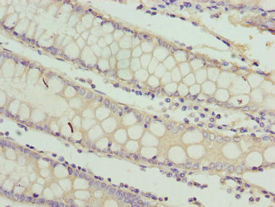 Immunohistochemistry of paraffin-embedded human colon cancer using CSB-PA019195LA01HU at dilution of 1:100